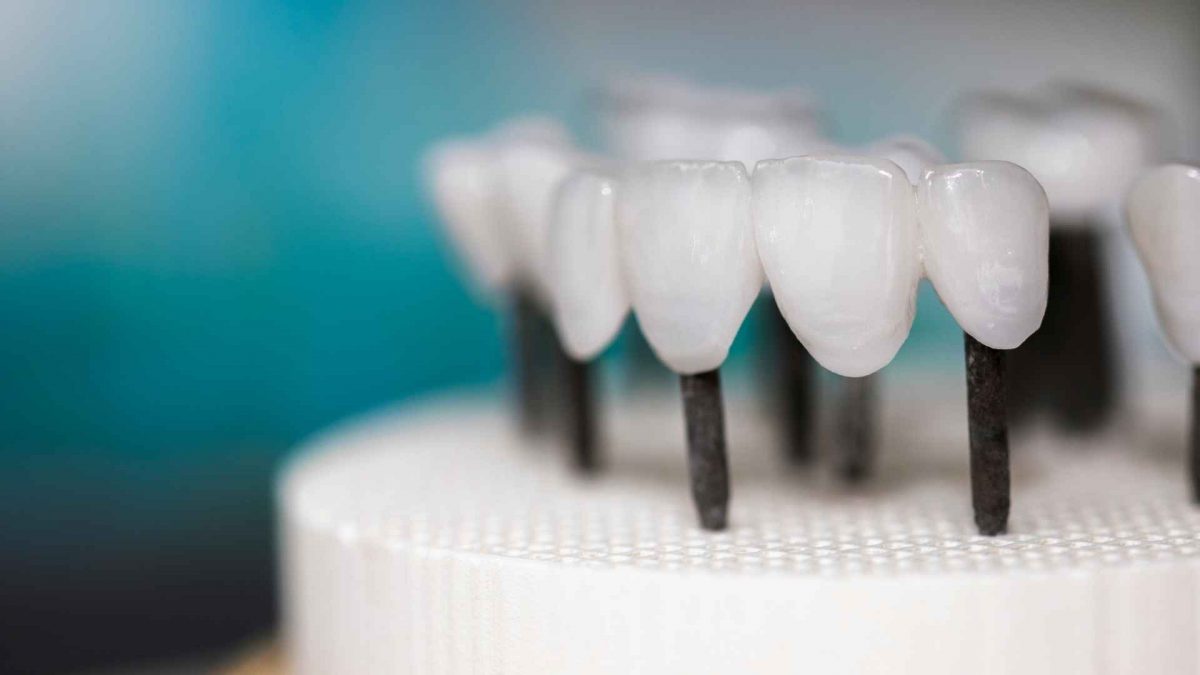 גלו את היתרונות של ציפוי שיניים זרקוניה לחיוך מהמם